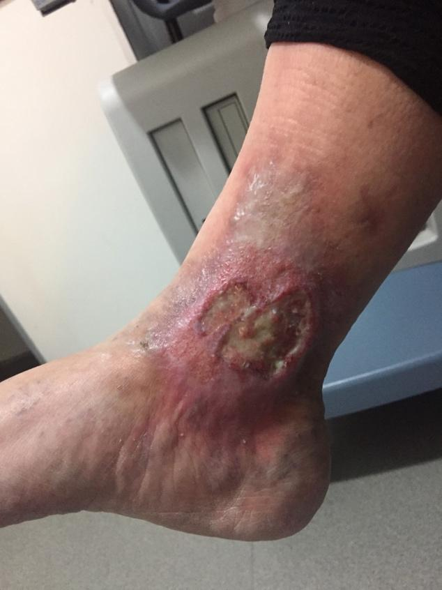 úlcera-piernas-centro-vascular
