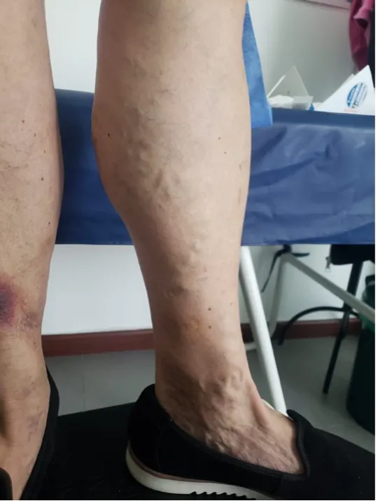 venas-varices-obesidad